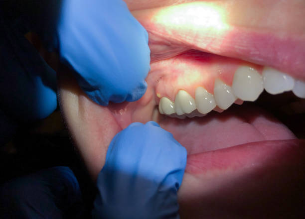 Best Emergency Care for Gum Disease in Pleasant Ridge, MI
